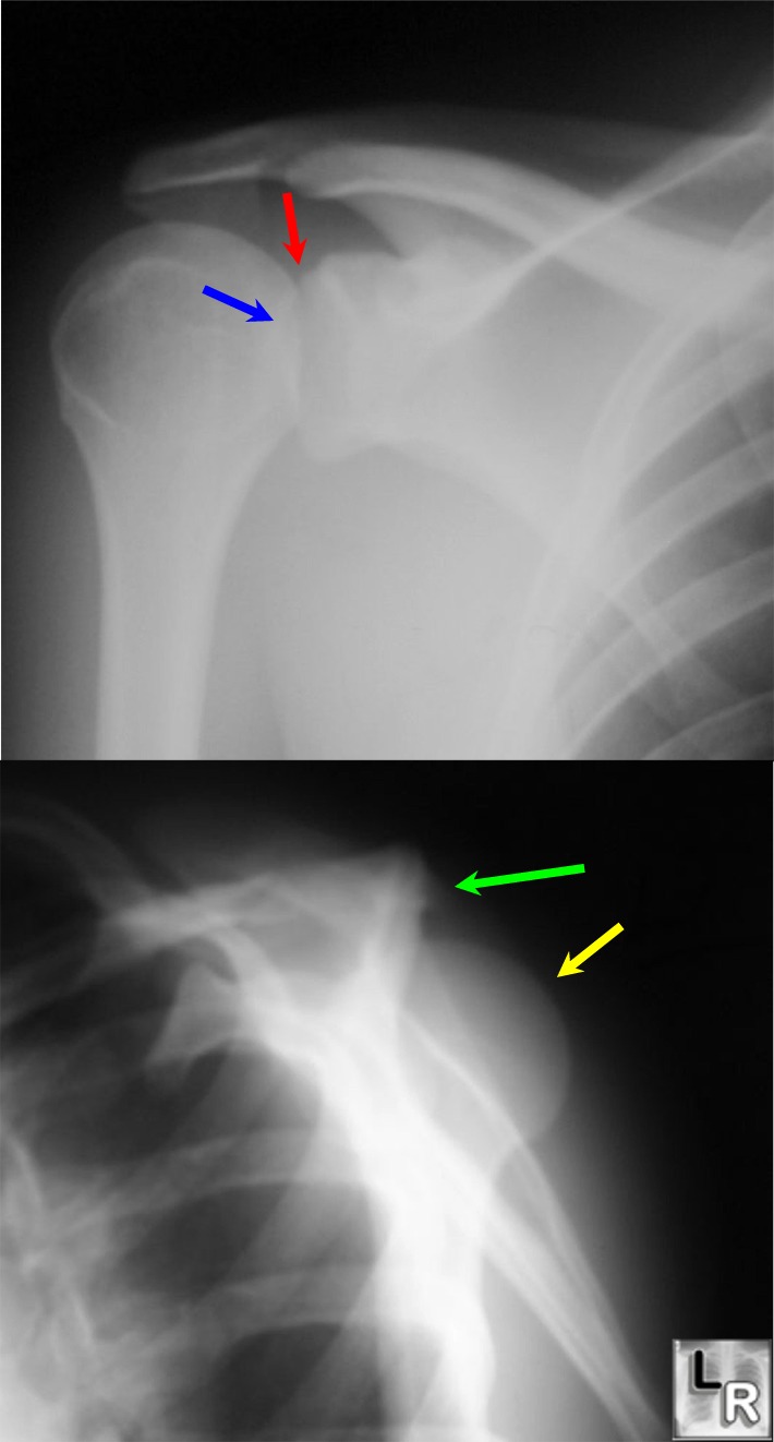 Tuberosity Humerus