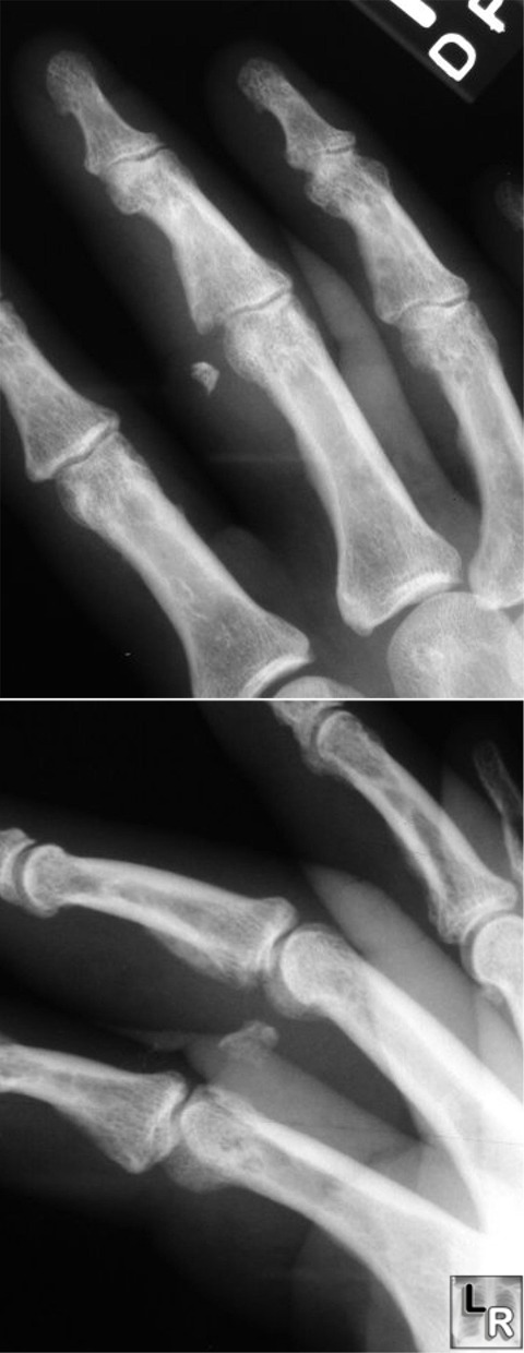 Phalanx Fracture Finger