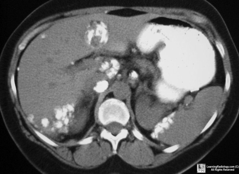 hepatic cyst on liver