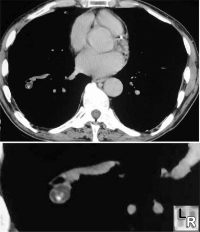hamartoma of lung