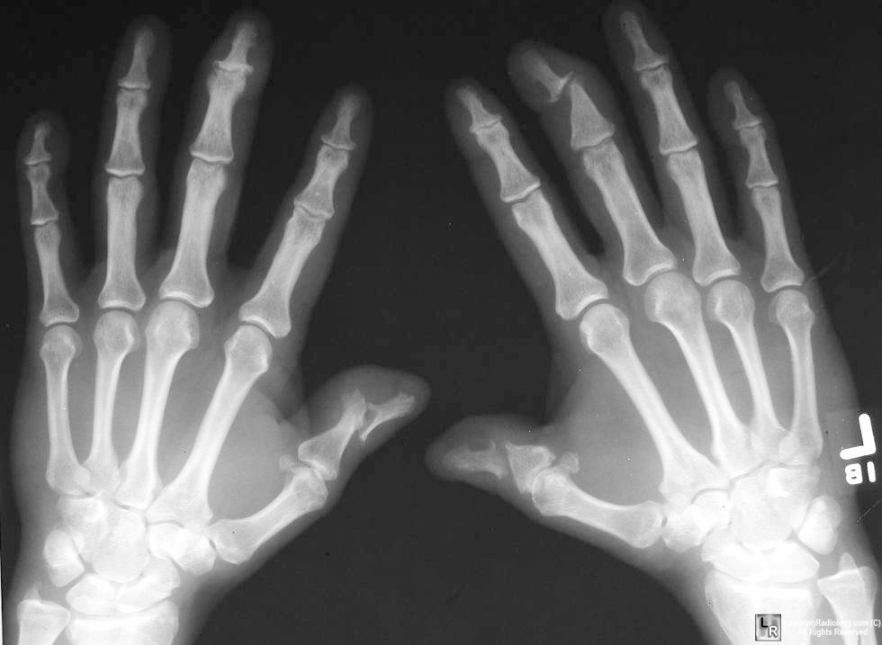 psoriatic arthritis radiology