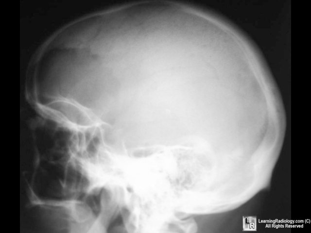Paget skull, Osteoporosis circumscripta
