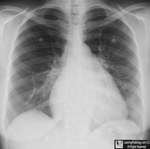 aortic stenosis x ray