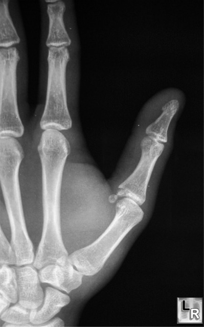 Metacarpal Fracture Xray