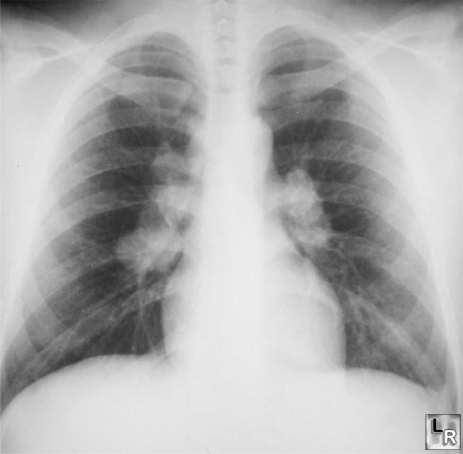 Learning Radiology Sarcoid Of The Lung