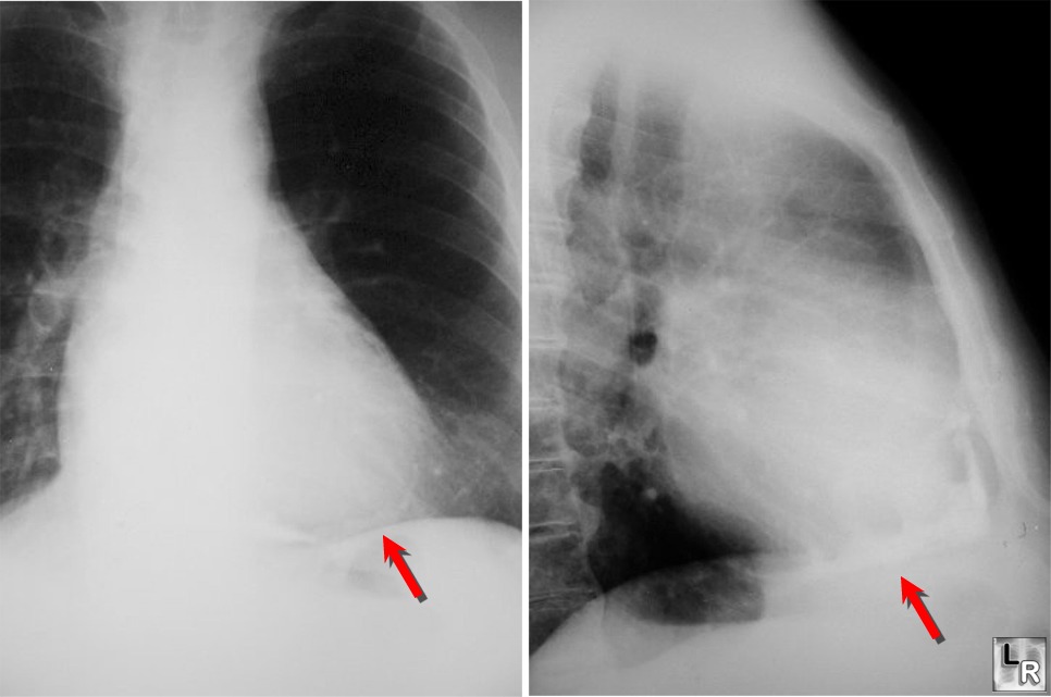 pericarditis symptoms