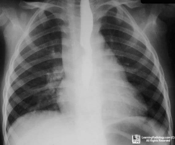 pulmonary sling