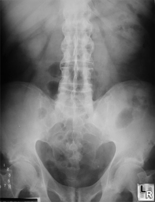 cervical ankylosing spondylitis x ray