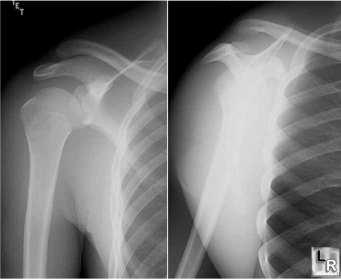 Classification of AC Joint Separation