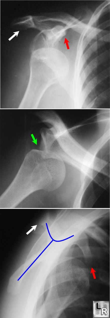 coracoid process fracture