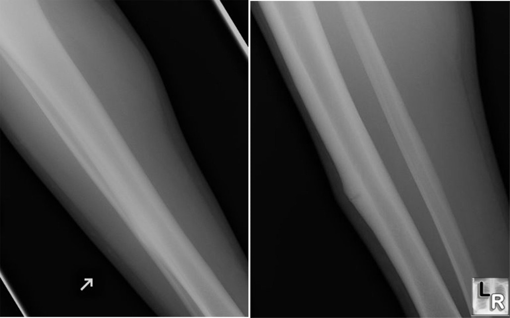 stress fracture tibia
