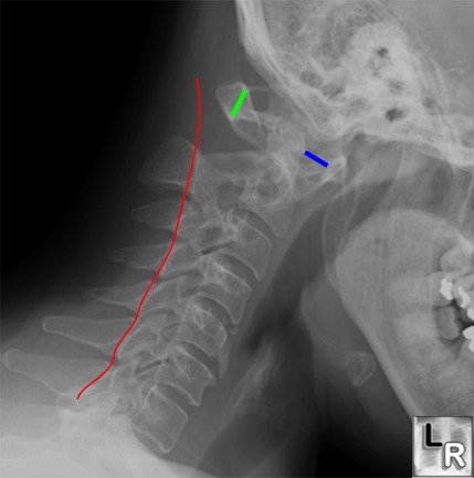 C1 C2 Ligaments