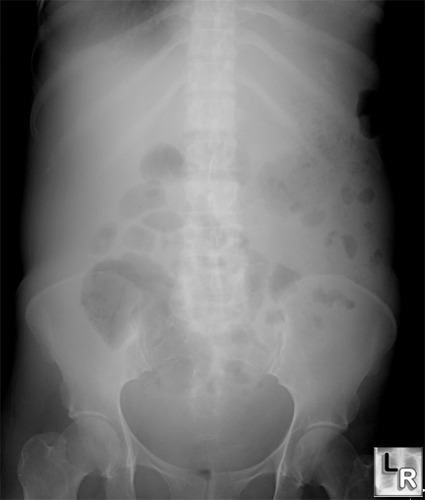 Learning Radiology Ascites