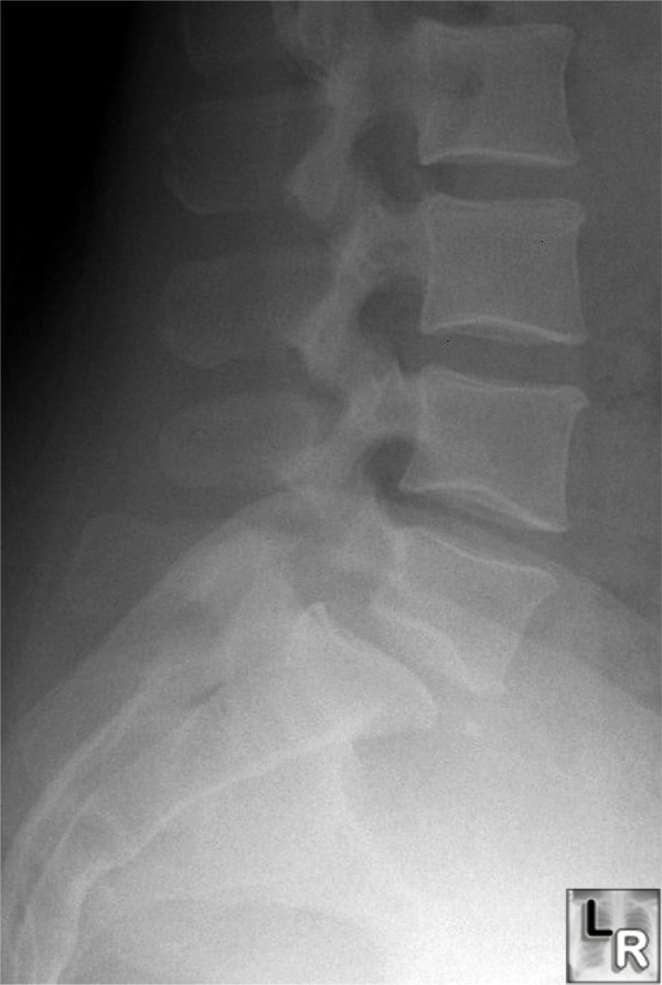 spondylolisthesis x ray