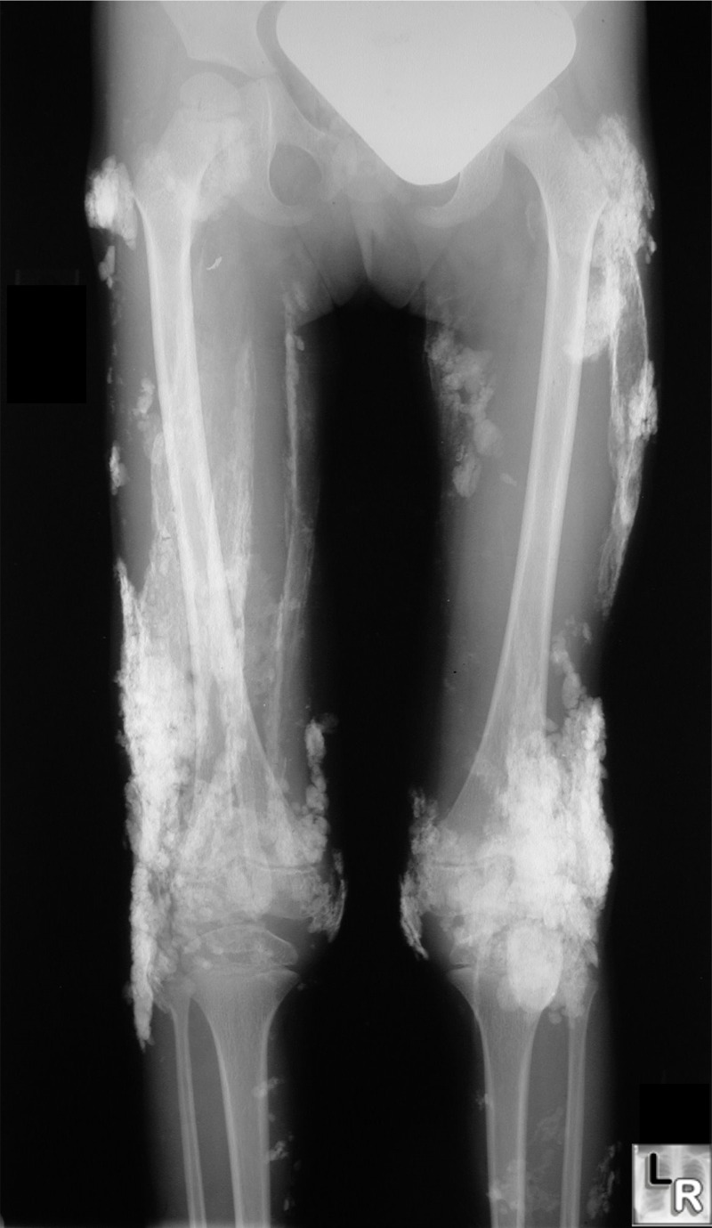 Learning Radiology Dermatomyositis Polymyositis Calcinosis Universalis