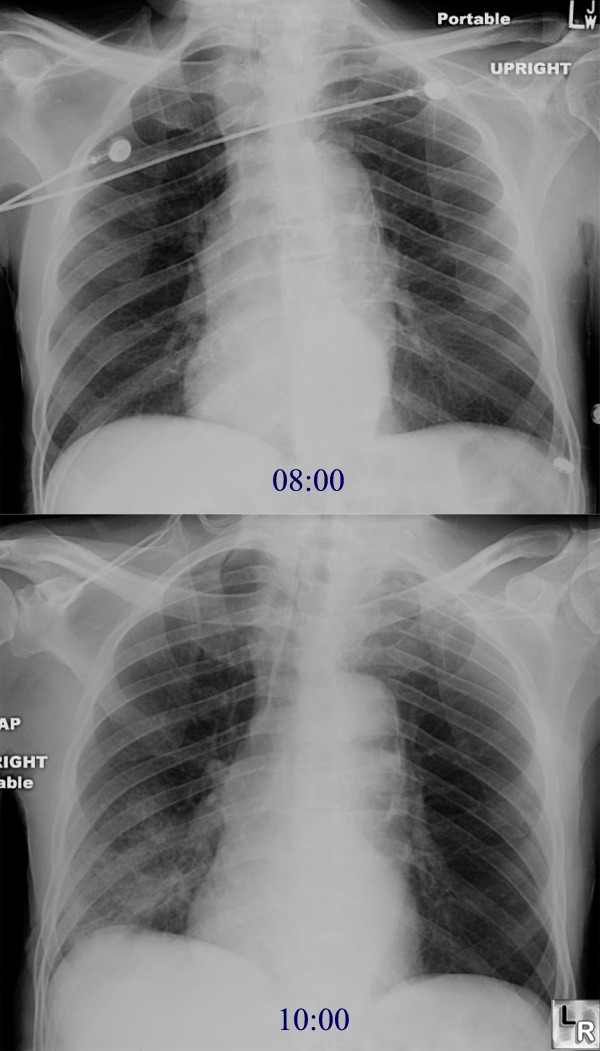 Aspiration Pneumonia Explained: Symptoms You Must Know 