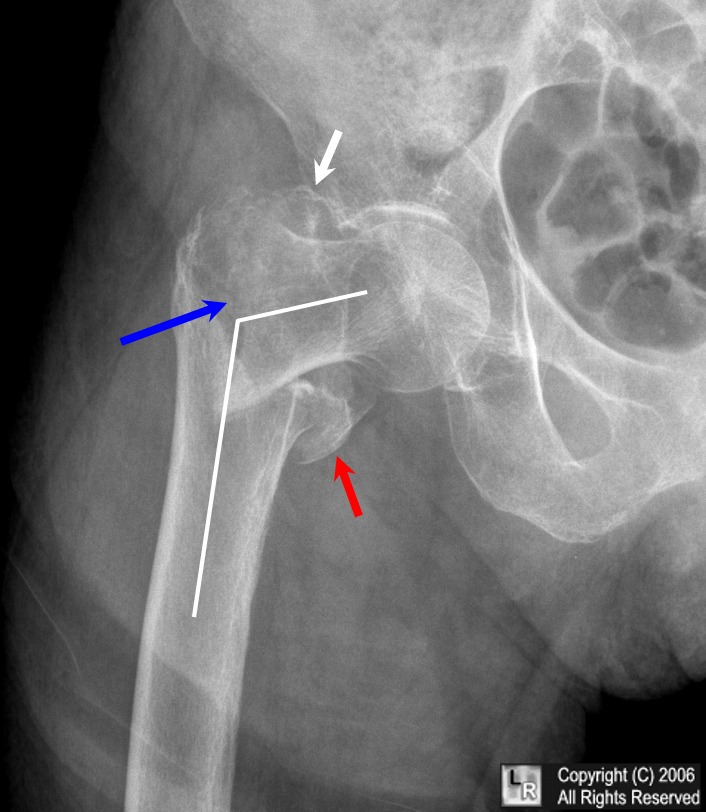 intertrochanteric fracture