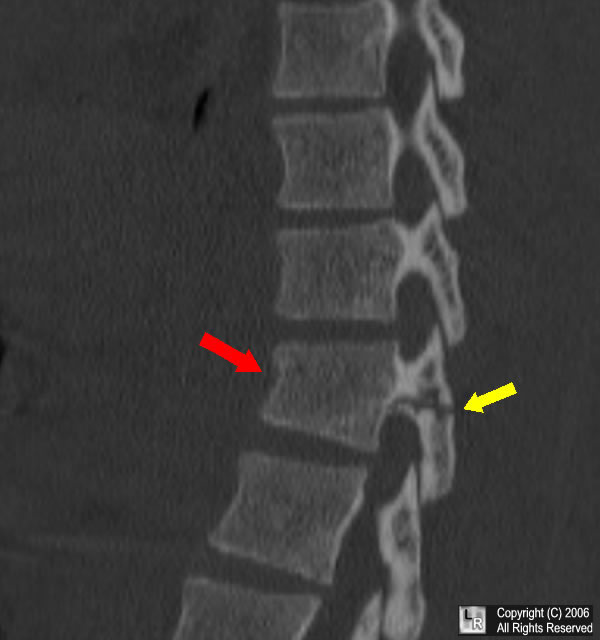 cracked disk xray lumbar spine