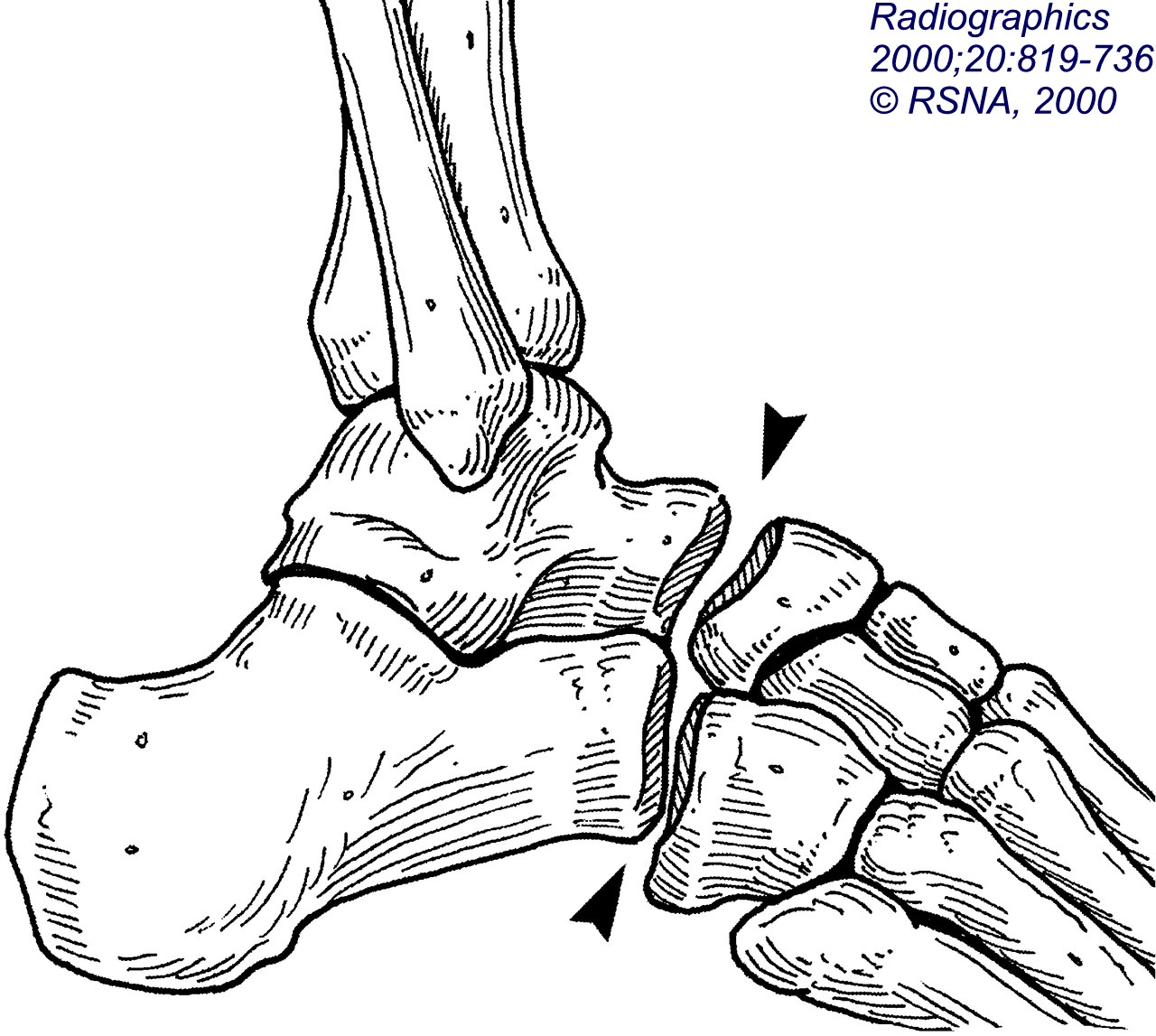 Learning Radiology chopart fracture dislocation