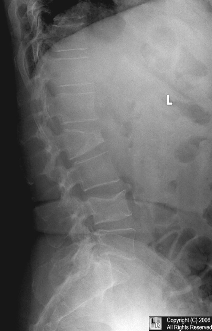 Multiple myeloma-spine