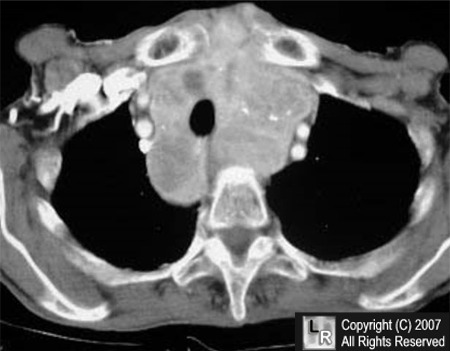 Thyroid goiter, CT,thyroid mass, image