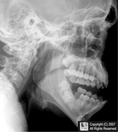 mandible fracture x ray