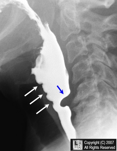 prominent cricopharyngeus