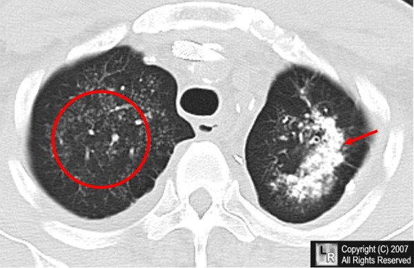 Click to enlarge Metastatic calcification, lungs, CT, image