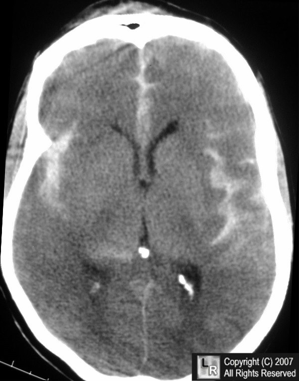 CT brain image gallery - SAH