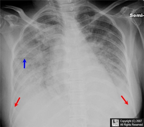 Pulmonary Alveolar Edema
