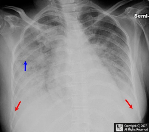 chf lung sounds