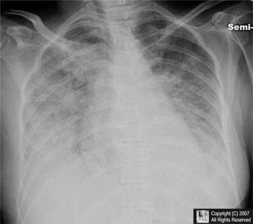 pulmonary edema radiograph