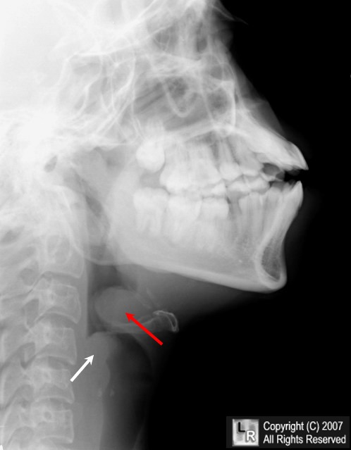 Lingual Hematoma