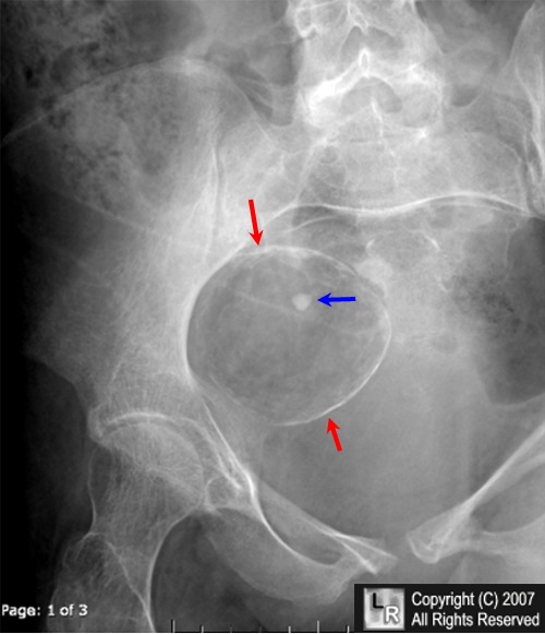 Learning Radiology Dermoid Cyst Ovary Teratoma Rupture Tooth 