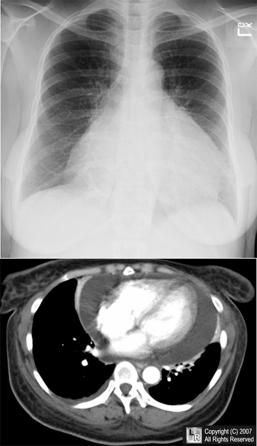 pericardial effusion x ray