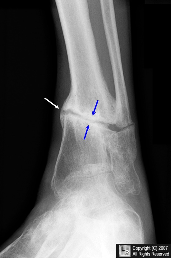 Malunited fracture - tibia, Radiology Case