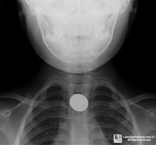 LearningRadiology - Coin, FB, foreign, body, esophagus