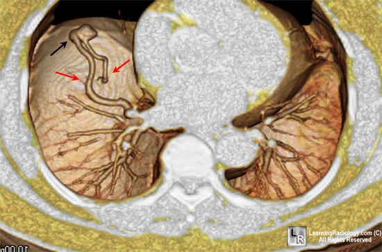 Avm Lung