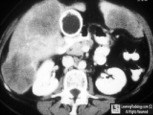 Carcinoma of the Gallbladder