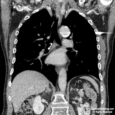 netspot neoendocrine tumor santa fe