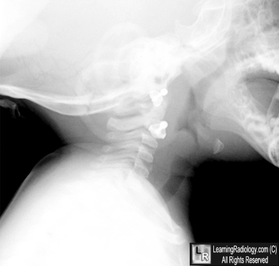 papillomatosis x ray