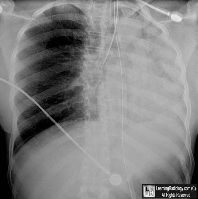 endotracheal tube placement x ray