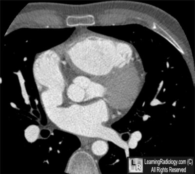 sinus venosus asd