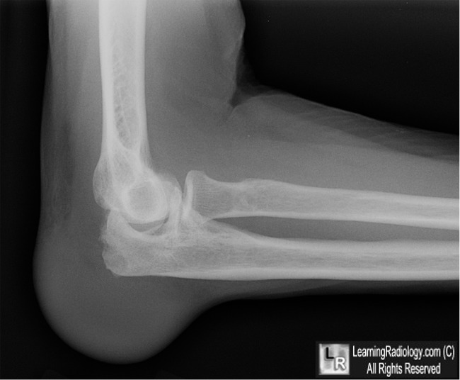 olecranon bursitis xray