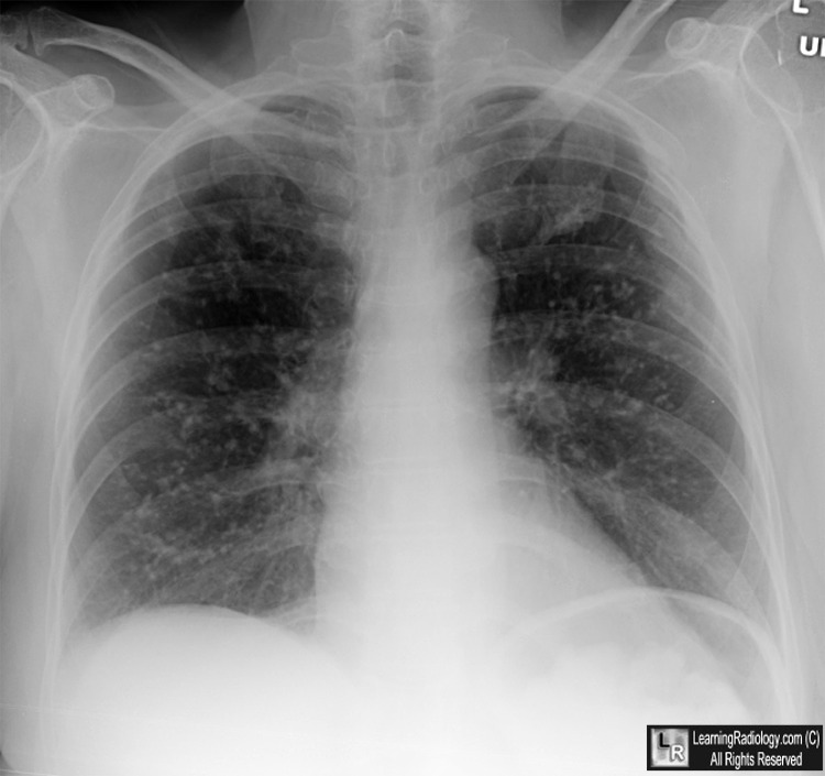 Mycoplasma pneumonia: MedlinePlus Medical Encyclopedia