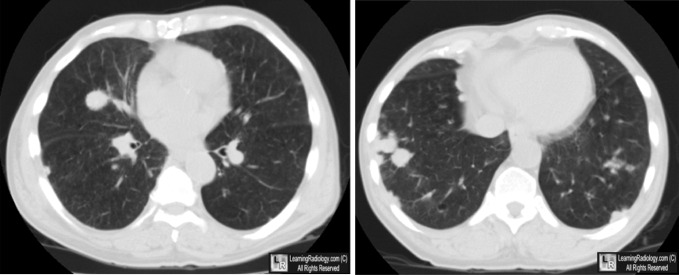 rheumatoid arthritis radiology lung