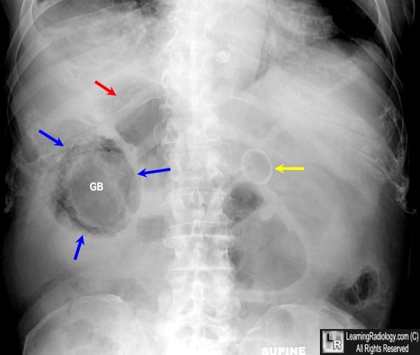 Emphysematous Cholecystitis