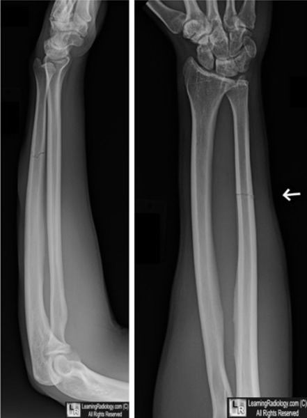 Welcome To Learningradiology - Ureteritis, Cystica, Pyelitis, Cystitis 