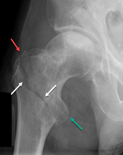 intertrochanteric fracture femur