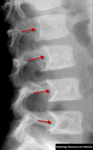 posterior vertebral scalloping